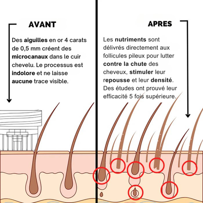 Système de repousse des cheveux AlphaInfuse™