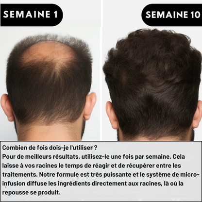 Système de repousse des cheveux AlphaInfuse™